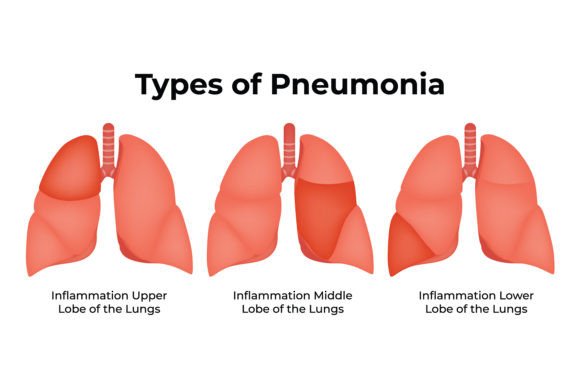 Download Types of Pneumonia Science Design Vector - Pneumonia Collection