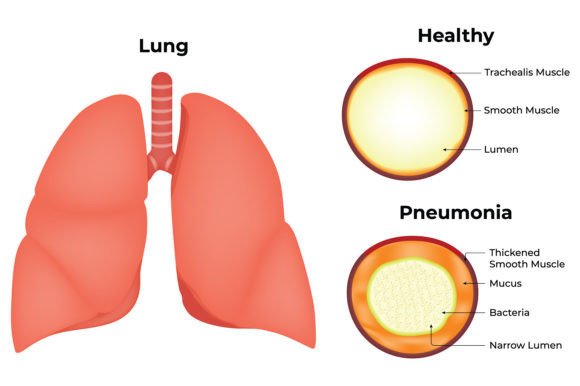 Download Lung Healthy Pneumonia Science Design - Pneumonia Collection